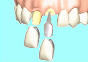 差し歯の種類